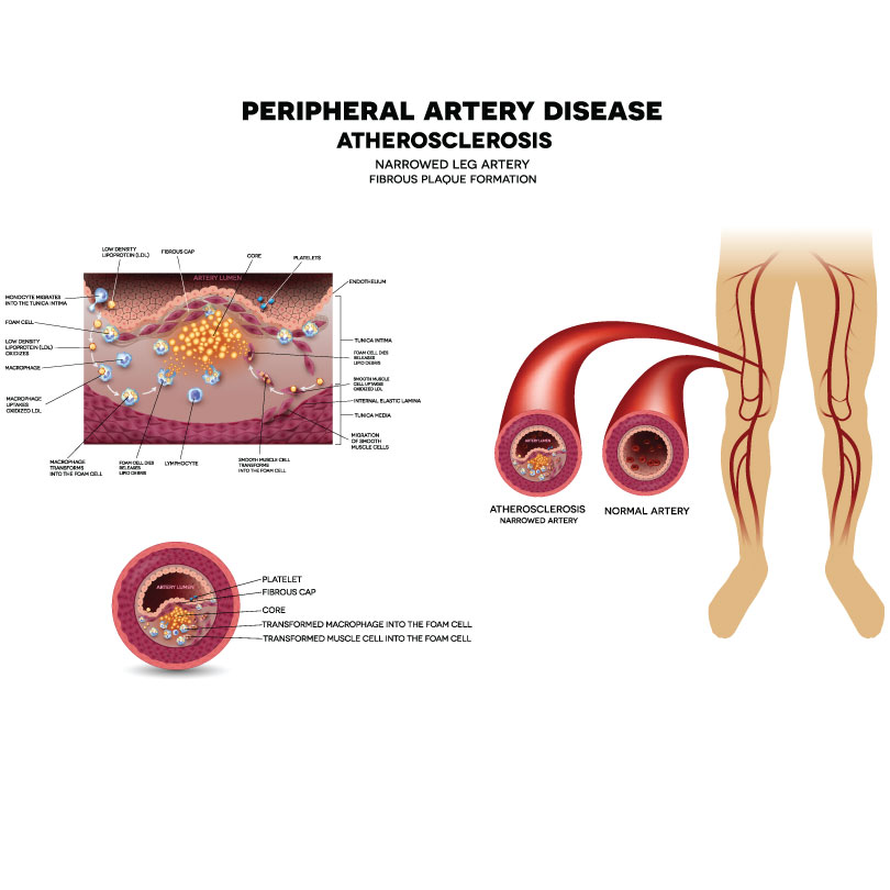 peripheral artery disease diagram - MVS Podiatry Associates