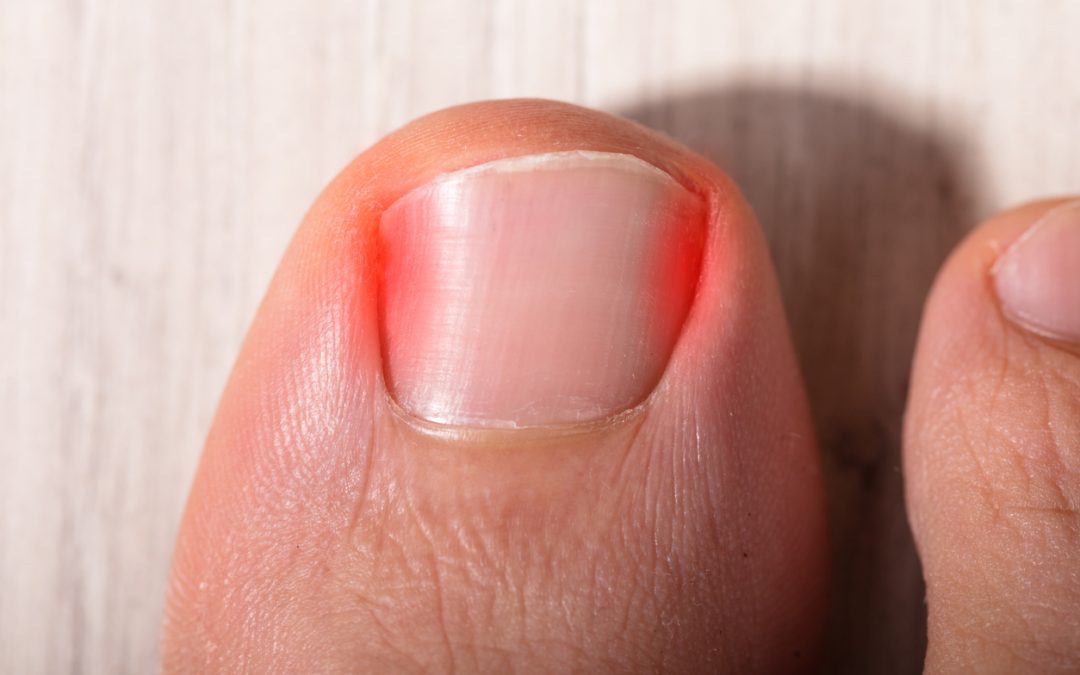 When Should You Go to the Doctor for an Ingrown Toenail?