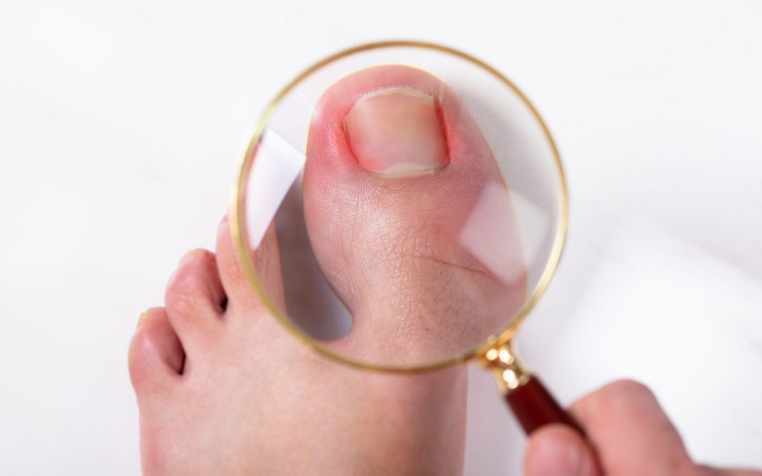 What are the Misconceptions about Ingrown Toenails?