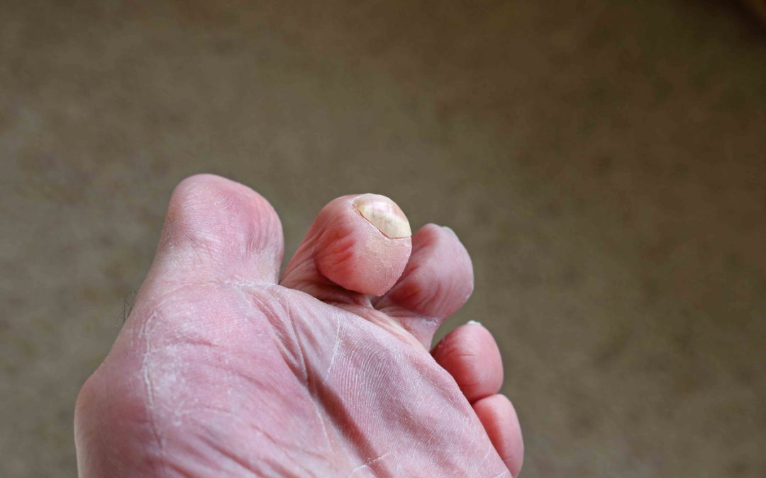How Do You Fix a Hammer Toe?