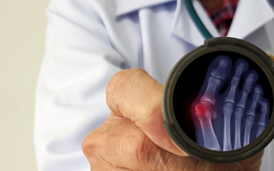 What You Should Know About Minimally Invasive Bunion Surgery