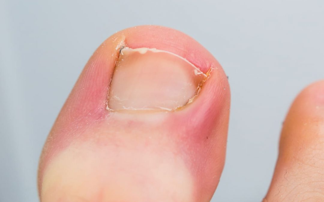 How to Treat an Infected Ingrown Toenail