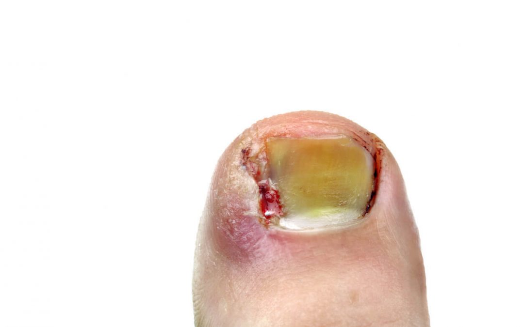 What Happens If an Ingrown Toenail Goes Untreated?