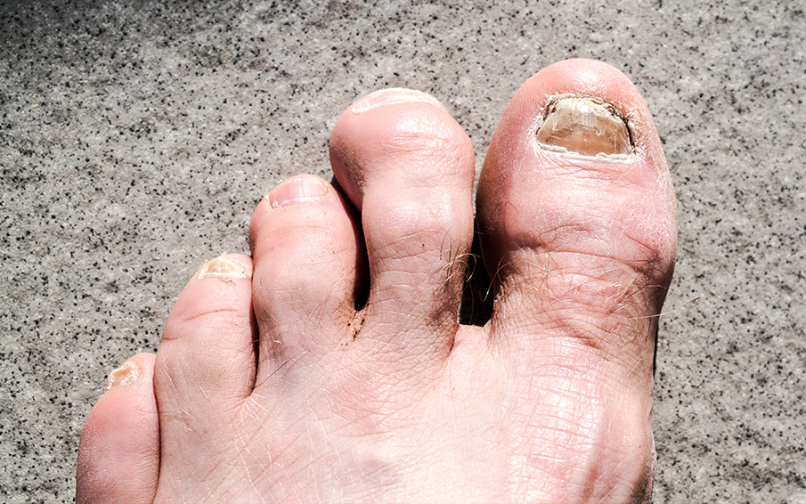 3 Ways You Can Prevent & Cure Hammer Toes