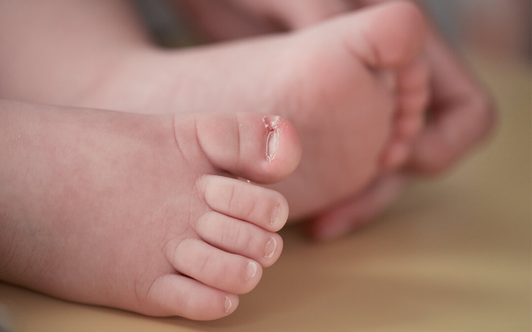How To Prevent And Treat Your Baby’s Ingrown Toenails