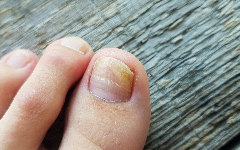 Say Goodbye to Ingrown Toenails with Podiatry Associates